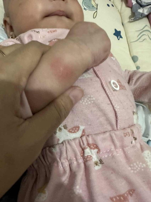 Bintik merah ditangan