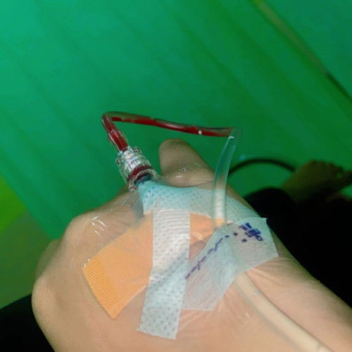 Tindakan Sc 11 Desember 2024,Anak kedua,punya riwayat Sc anak pertama