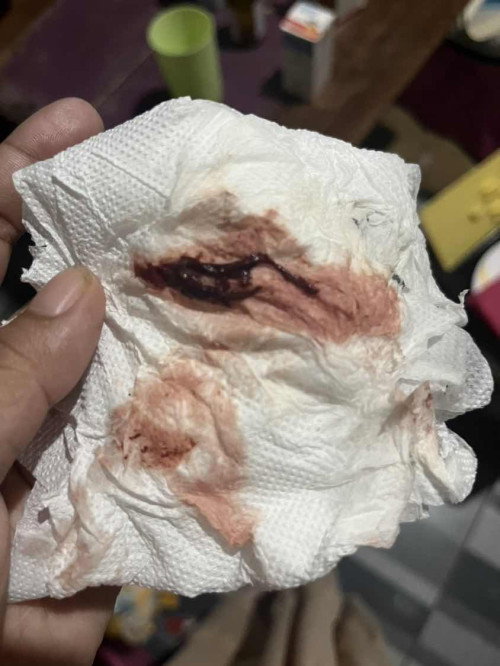 Bleeding at 13 weeks