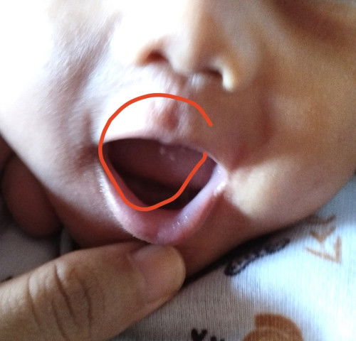 Lidah bayi ada bintik putih