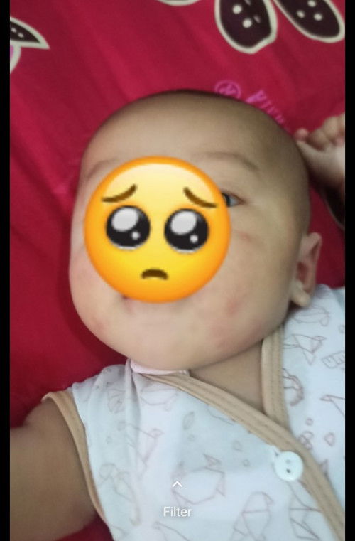 Bayi usia 2 bulan keluar bintik merah/biang keringat