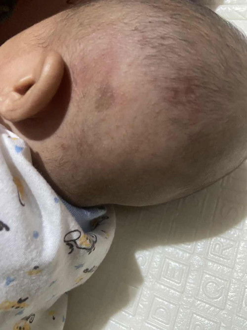 Merah2 ini herpes atau apa ya bun?