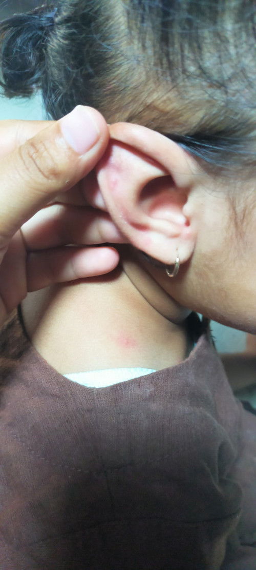 Gatal di daun telinga