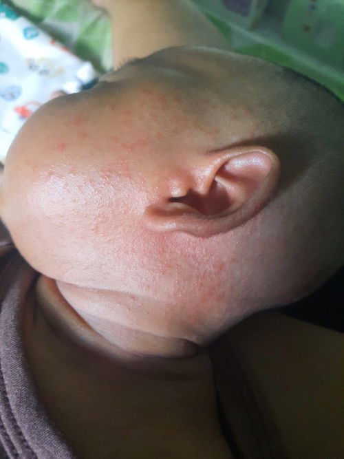 Solusi kemerahan di badan bayi