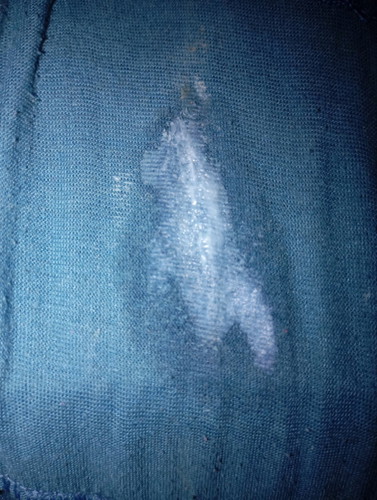 White Discharge