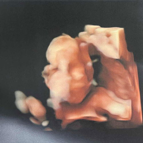 ท้องแรก 20w+