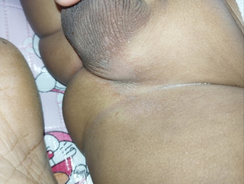 jamur selangkangan bayi