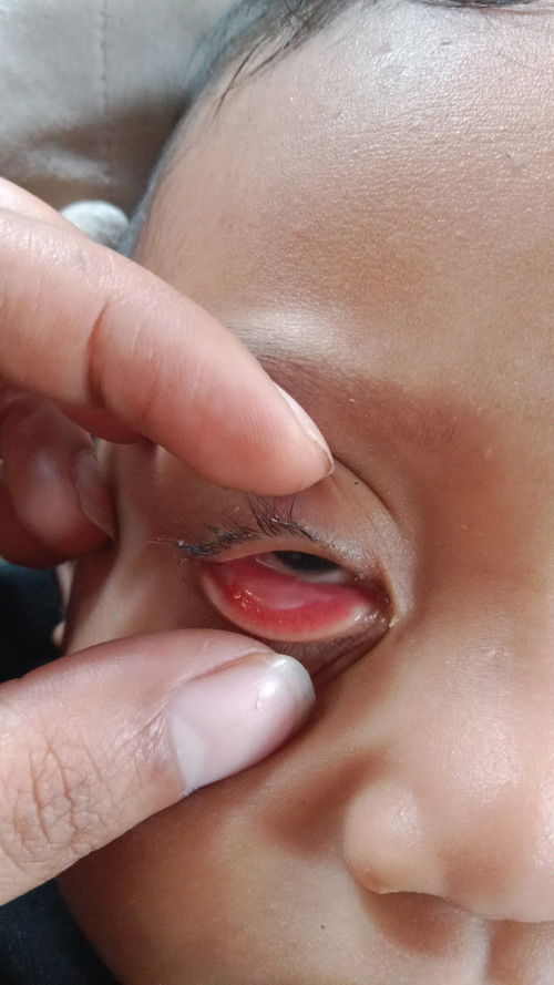 Ada yang pernah ngalamin anak nya sakit mata ga bund?