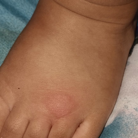 Bintik merah dekat baby