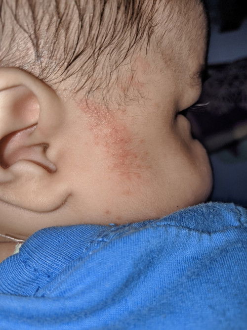 Ruam atau biang keringat