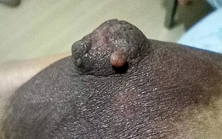 Normal po ba ito sa nipples?