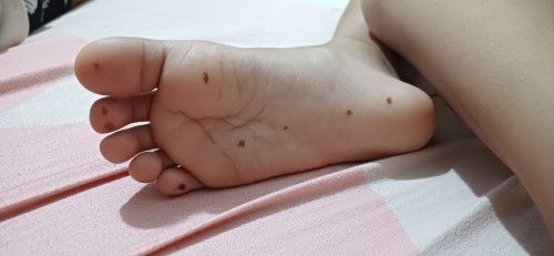 Bercak coklat ditelapak kaki