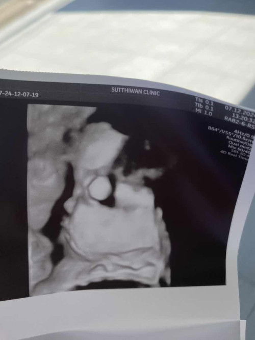 รกพาดคอ 35+5