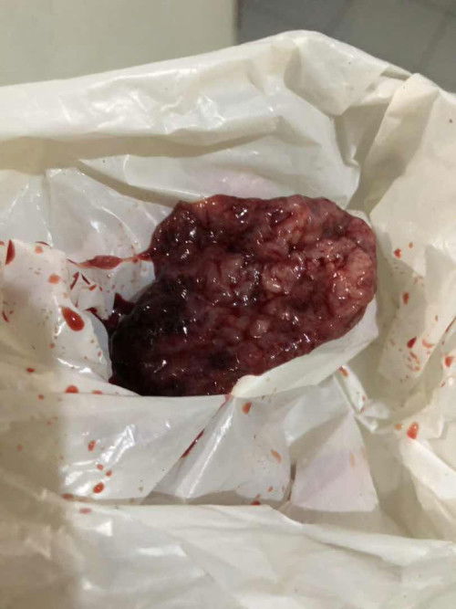 Keluar gumpalan daging saat haid setelah lahiran