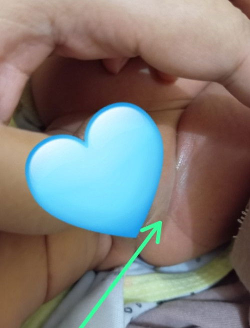 Ini lecet atau ruam ya di lipatan paha bayi?