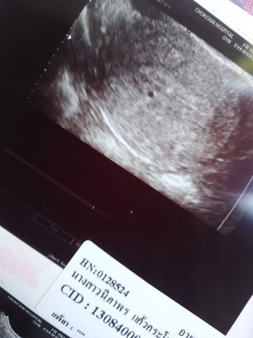 ใช่ถุงการตั้งครรภ์ไหมคะ