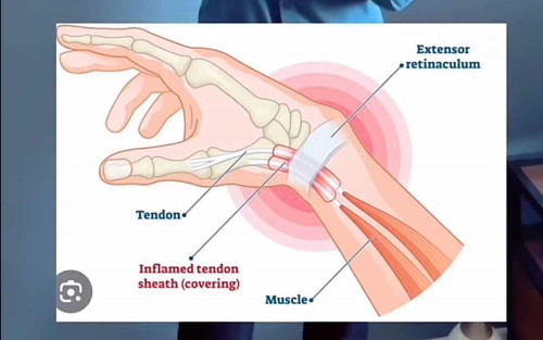sakit pergelangan tangan