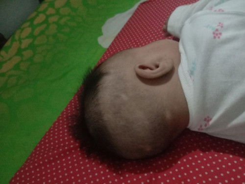 Kepala bayi seperti seperti bercak