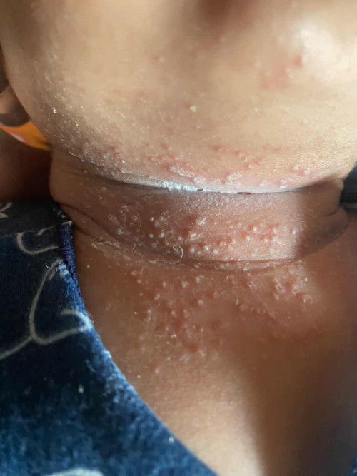 Bintik ruam di leher