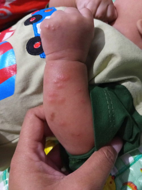 Kulit ruam bentol merah