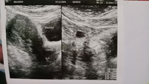 Usia kehamilan dihitung dari hpht 8week, dinyatakan kehamilan ektopik