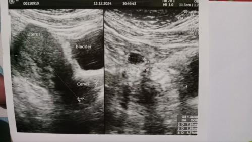 Usia kehamilan dihitung dari hpht 8week, dinyatakan kehamilan ektopik