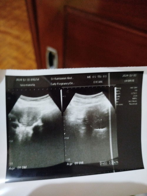 Usg 4minggu belum terlihat kantung janin