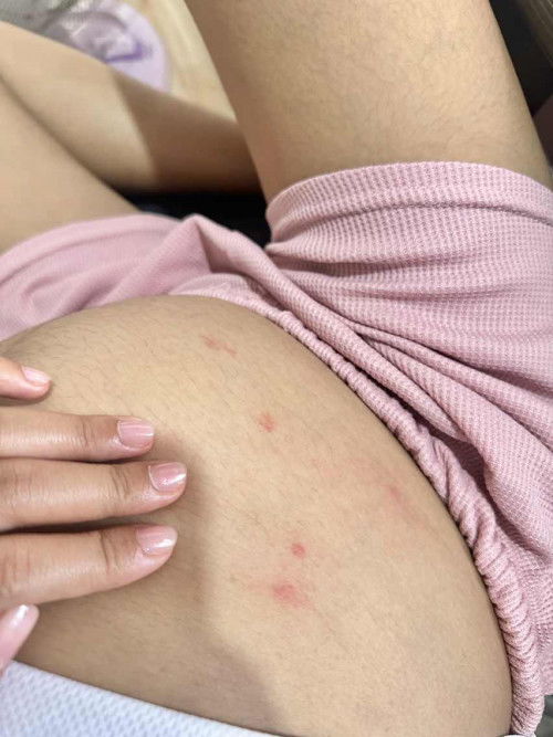 สอบถามหน่อยค่ะ วันที่11 มีจุดสีแดงขึ้นมา2จุด วันที่12ยังมี2จุด พอมาวันที่13 มีเพิ่มขึ้นมา3จุดจู่ๆก็มีขึ้นมาเอง ไม่ทราบว่าอันตรายมั้ยคะ