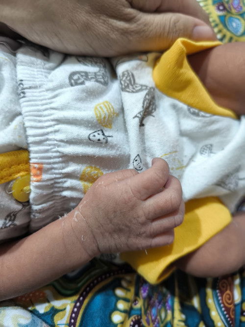 Kulit baby menggelupas