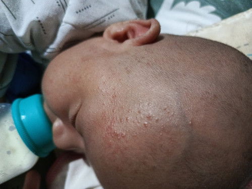 Kak muka anakku kok pada bintik" kyk gtu ya obatnya apa ,