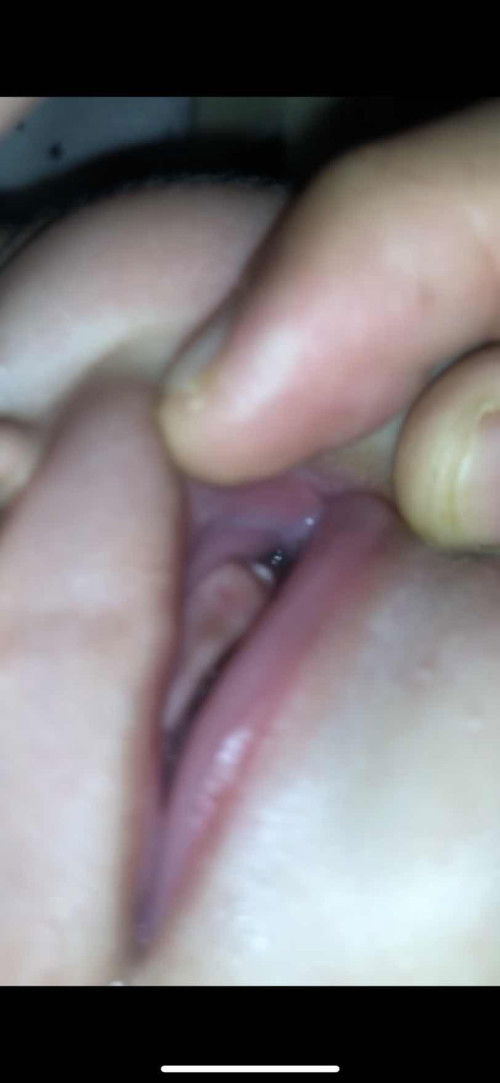 Bund Ini apayah Satu ttik di gusi berwrna putih trus keras  di gusi