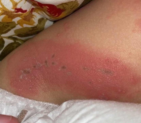 สอบถามค่ะผื่นเเบบนี้คือผื่นเกิดจากอะไร?