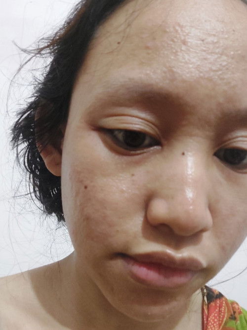 Sudah mau seminggu gatal & bruntusan