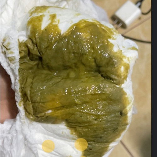 น้อง 6เดือนกับ1วัน ถ่ายเป็นน้ำสีเขียวมีเส้นเลือดนิดนึงป่นอยู่เกิดจากอะไรคะ