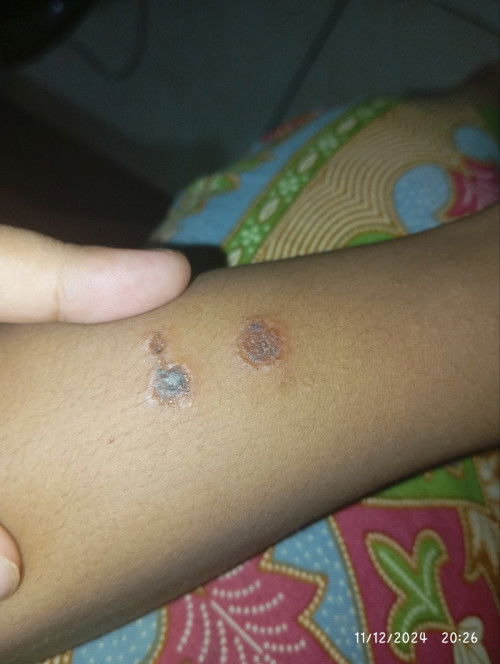 Awal nya cuma bintik bintik kaya di gigit nyamuk gitu