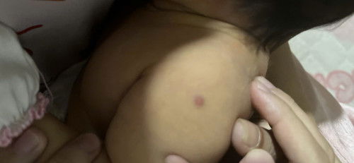 Bé bị sưng chỗ tiêm hồi mới sanh