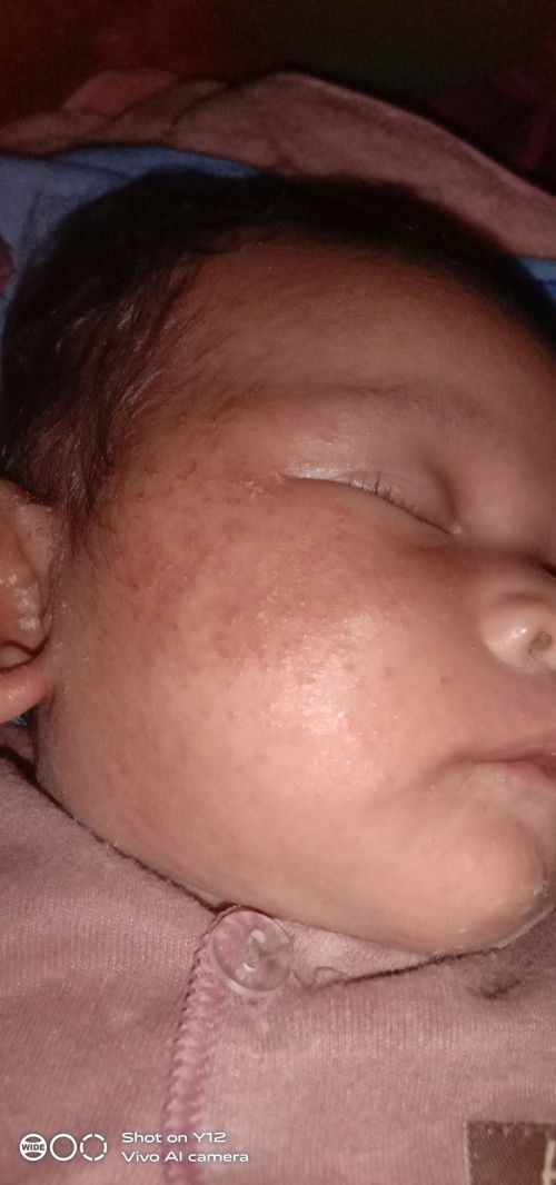 Ruam bintik merah pada wajah