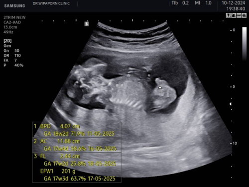 18สัปดาห์4วัน