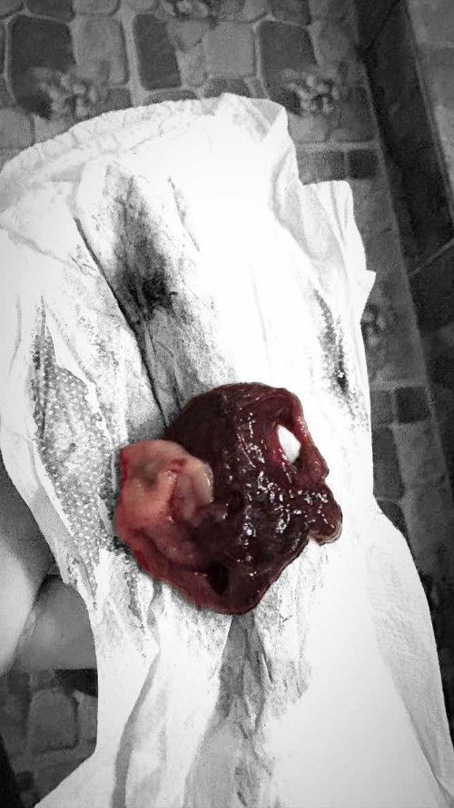 ก้อนเลือดมีสีขาว