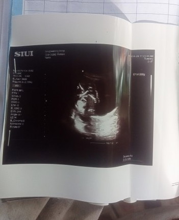 ซาวช่วง5เดือน หมอบอกน้องเอาขาบังไว้ เดาๆน่าจะเป็นผู้หญิงทำเพราะไม่เห็นจู๋