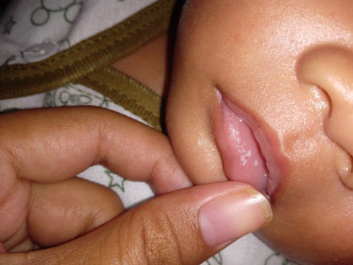 bintik putih dimulut