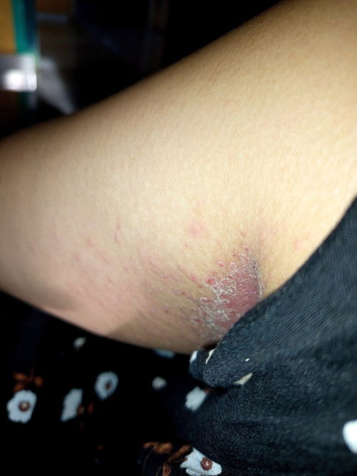 Ruam di ketiak bunda