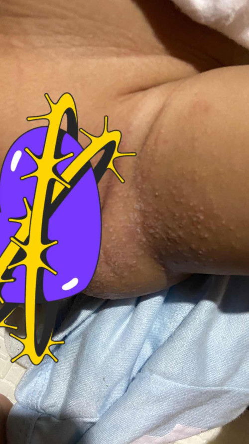 Gatal gini dikasih apa ya bun ?