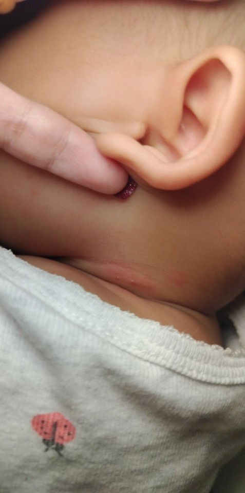 ตุ่มแดงๆเล็กๆคล้ายมีหนอง