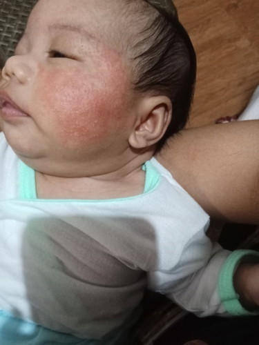 Sa pedia ba or sa dermatologist ipacheck up ang skin ni baby?