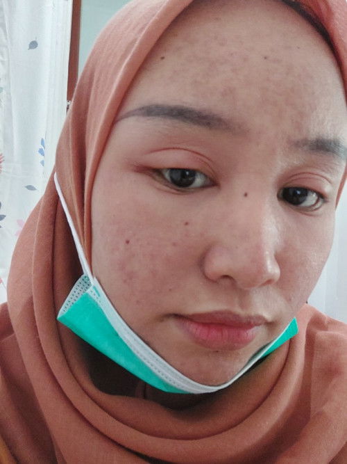 Mata & wajah bengkak