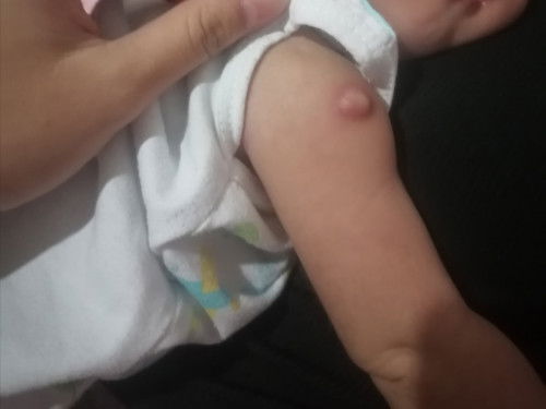 Namaga at may nana ang braso dahil sa BCG VACCINE