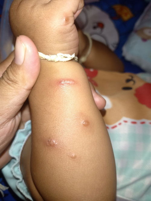 แพ้ยุงกัด ยุงกันแล้วพุพอง