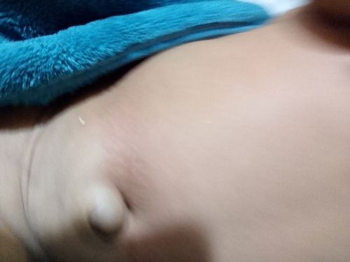 Pusat bayi 1 bln 24 hari nonjol/bodong
