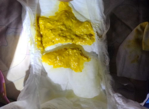 Bayi 3 bulan tekstur pupnya seperti ini normal kah bun?